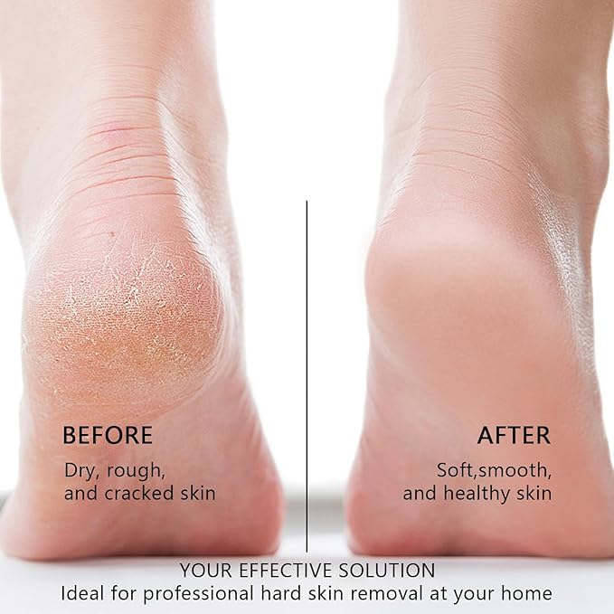 Electric Foot Exfoliator – Rechargeable Waterproof Scrubber with 3 Speeds