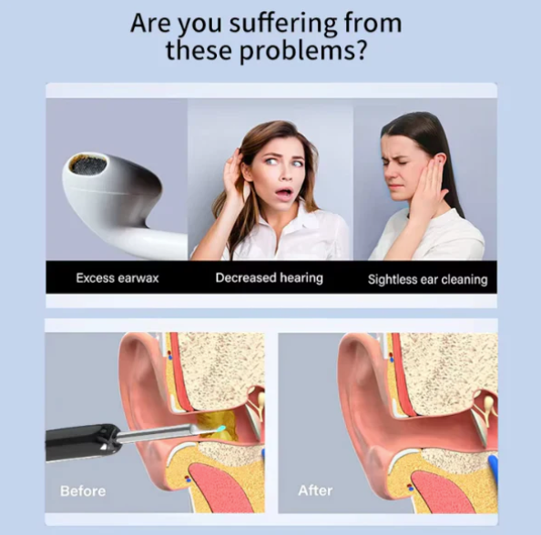 Ear Wax Cleaner Kit with HD WiFi Camera – Reusable Otoscope Tool